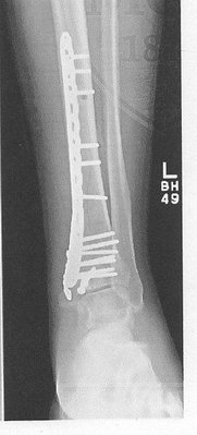 leg xray.jpg